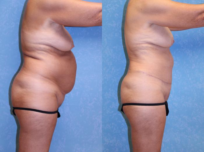 Before & After Abdominoplasty Case 600 Right Side View in Toledo, Ohio