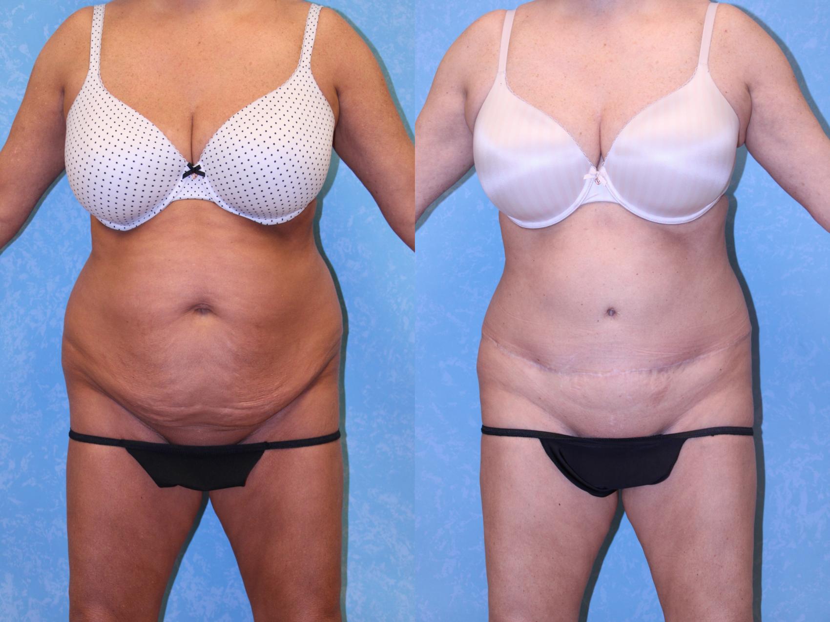 Before & After Abdominoplasty Case 601 Front View in Toledo, Ohio