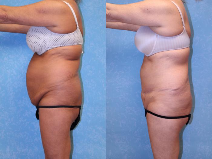 Before & After Abdominoplasty Case 601 Left Side View in Toledo, Ohio