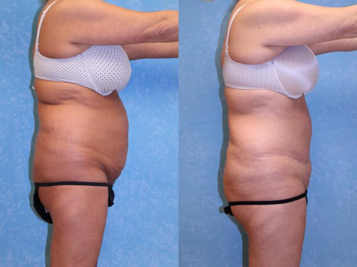 Before & After Abdominoplasty Case 601 Right Side View in Toledo, Ohio