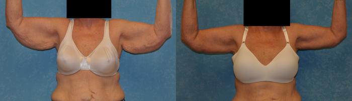 Before & After Arm Lift Case 391 Front View in Toledo, Ohio
