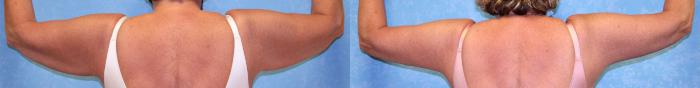 Before & After Arm Lift Case 473 Back View in Toledo, Ohio