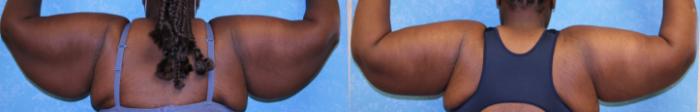 Before & After Arm Lift Case 474 Back View in Toledo, Ohio