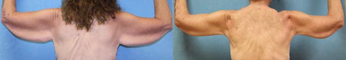 Before & After Arm Lift Case 508 Back View in Toledo, Ohio