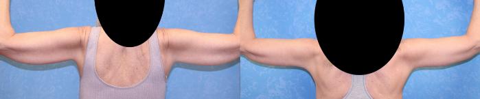 Before & After Arm Lift Case 551 Back View in Toledo, Ohio