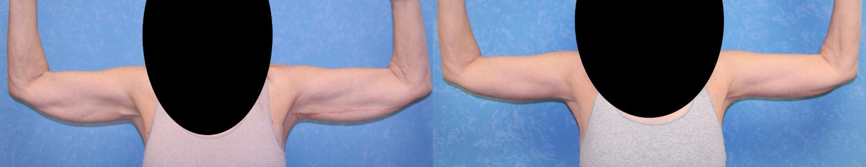 Before & After Arm Lift Case 551 Front View in Toledo, Ohio