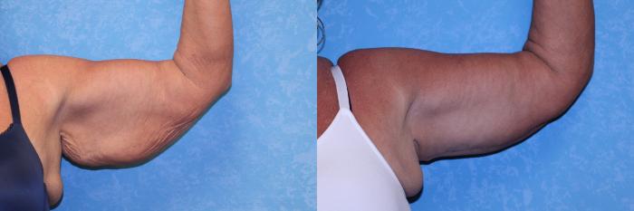 Before & After Arm Lift Case 559 Front Left View in Toledo, Ohio