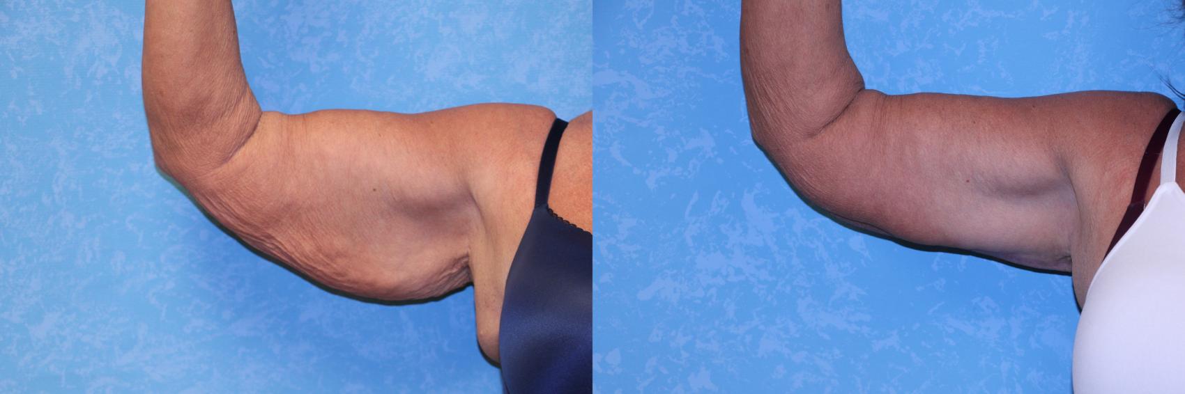 Before & After Arm Lift Case 559 Front Right View in Toledo, Ohio