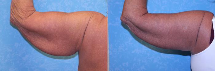 Before & After Arm Lift Case 559 Posterior Left View in Toledo, Ohio