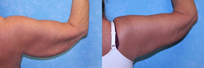 Before & After Arm Lift Case 559 Posterior Right View in Toledo, Ohio