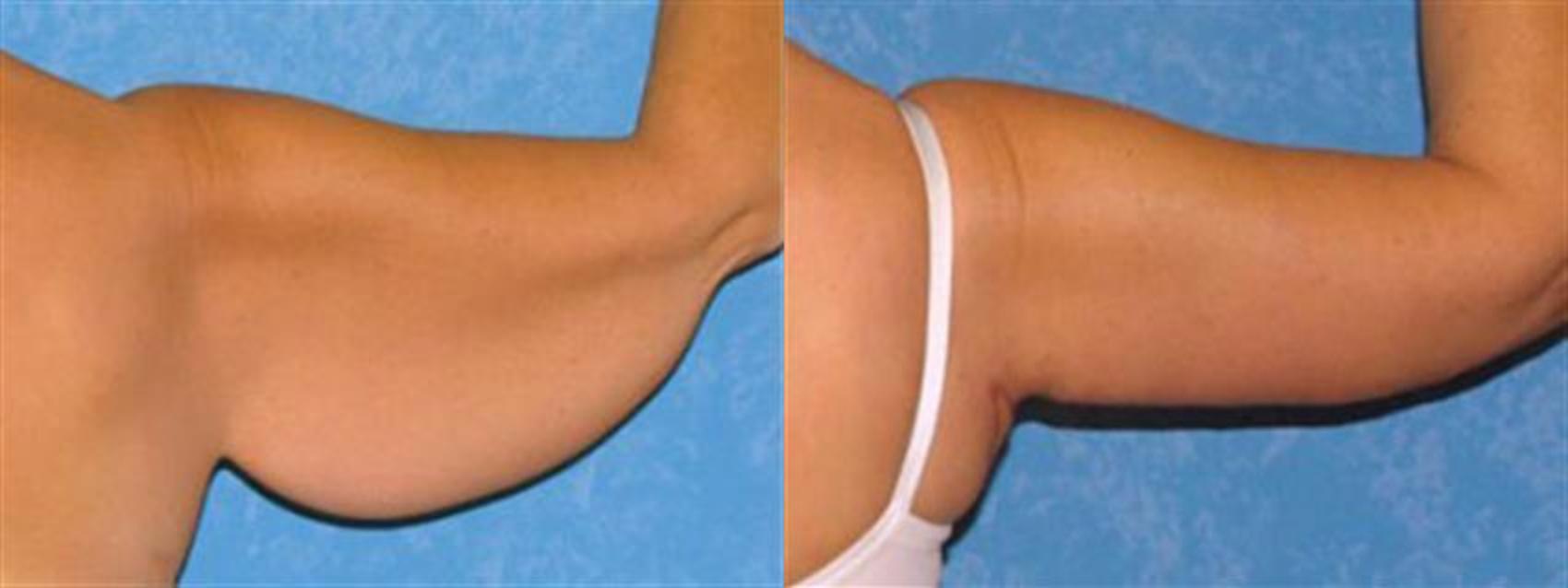 Before & After Arm Lift Case 80 View #2 View in Toledo, Ohio
