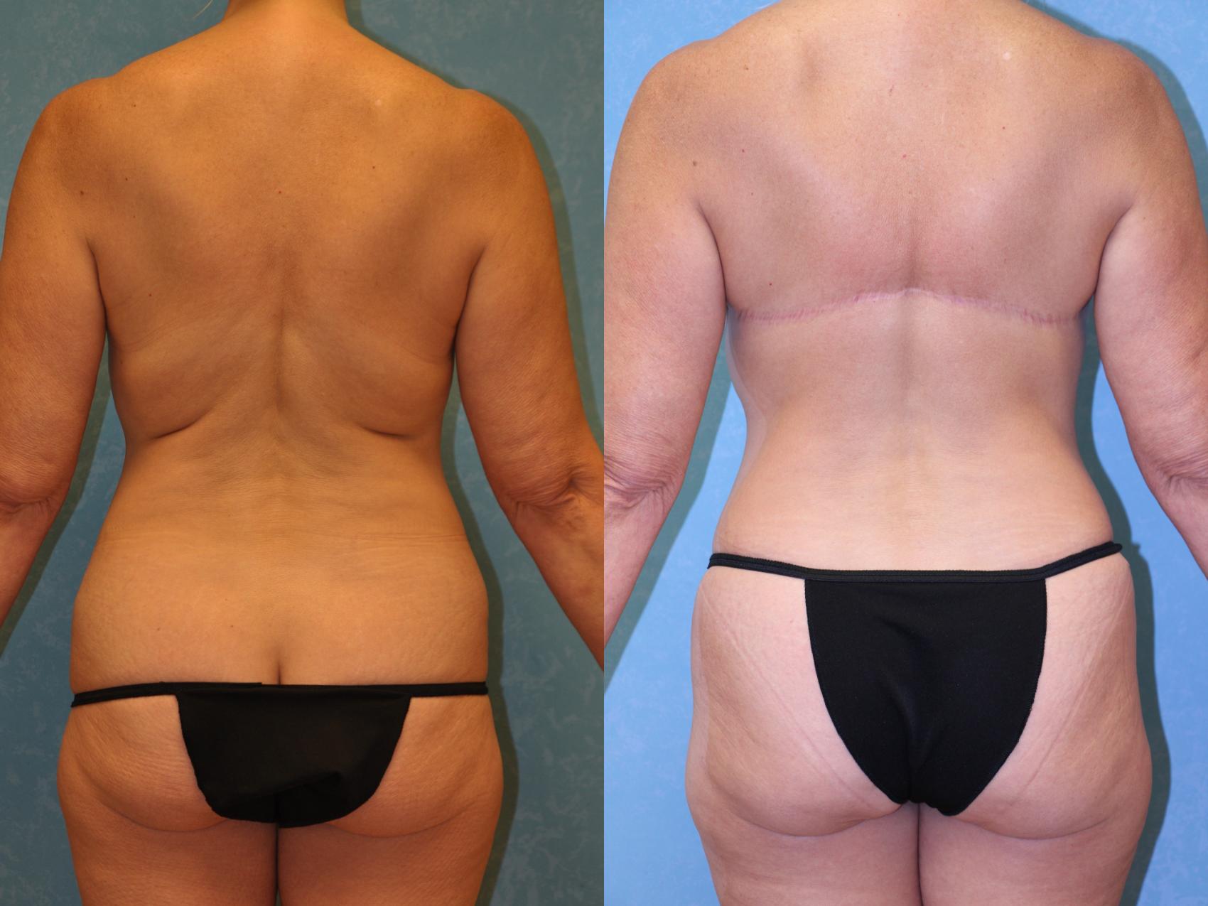 Before & After Abdominoplasty Case 445 Back View in Toledo, Ohio