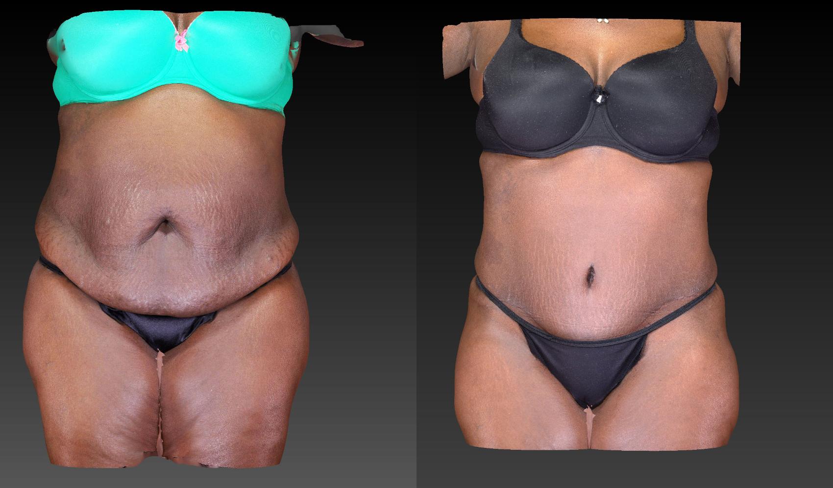 Before & After Body Contouring  Procedures Case 198 View #1 View in Toledo, Ohio
