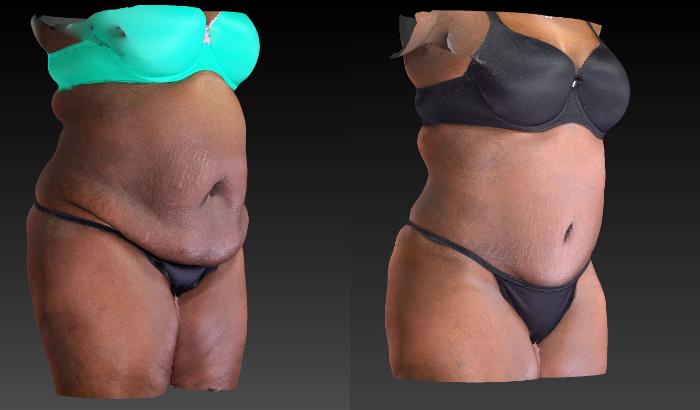 Before & After Body Contouring  Procedures Case 198 View #2 View in Toledo, Ohio