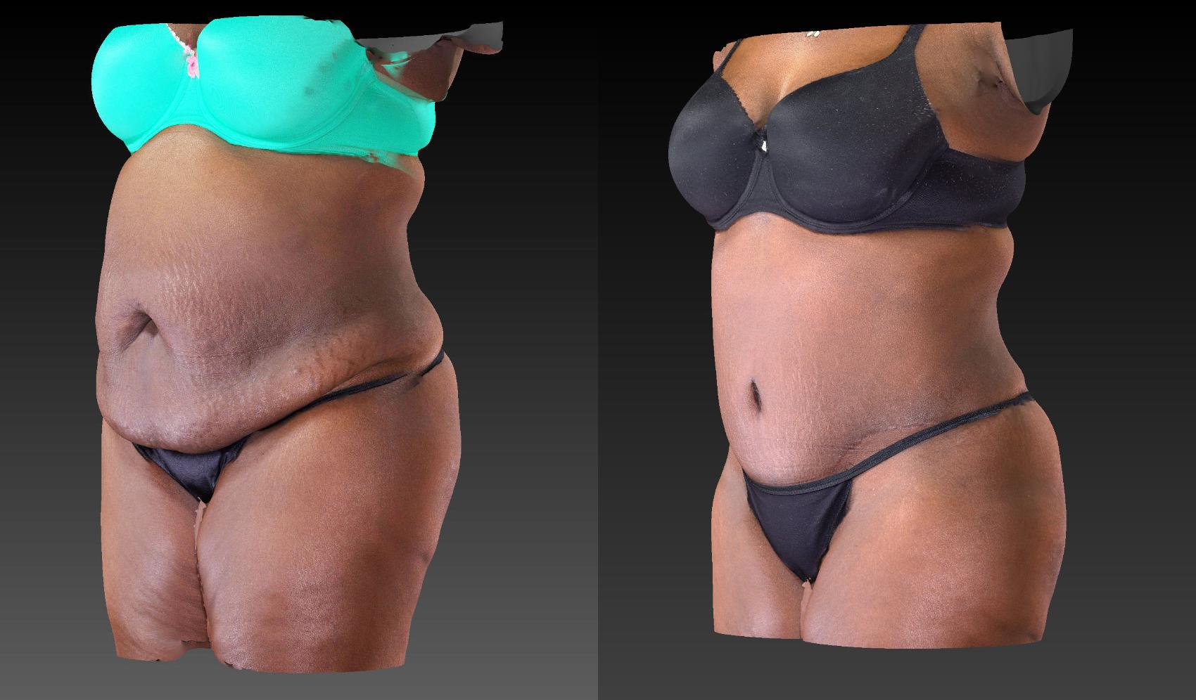 Before & After Body Contouring  Procedures Case 198 View #3 View in Toledo, Ohio