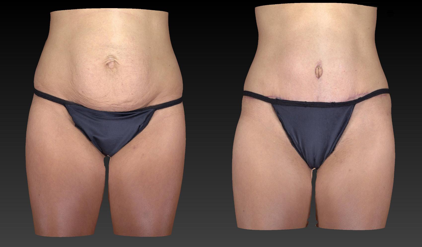 Before & After Body Contouring  Procedures Case 242 View #1 View in Toledo, Ohio