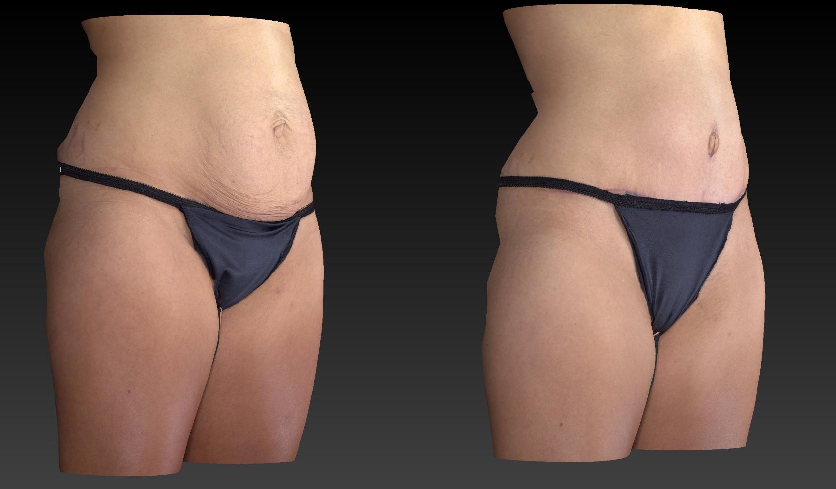 Before & After Body Contouring  Procedures Case 242 View #2 View in Toledo, Ohio