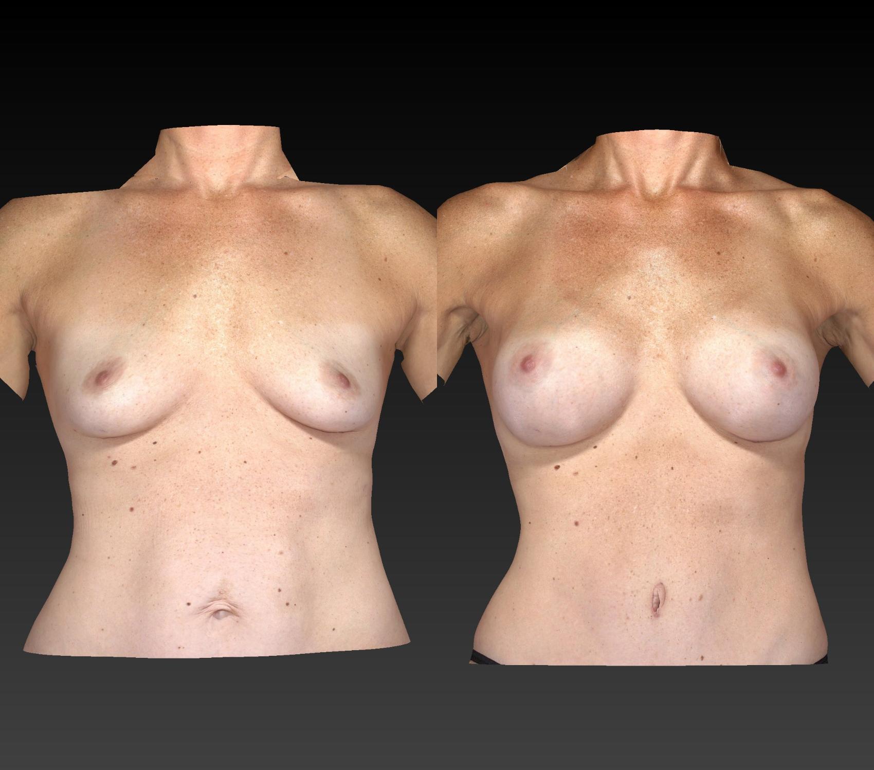 Before & After Body Contouring  Procedures Case 247 View #1 View in Toledo, Ohio