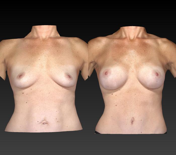Before & After Body Contouring  Procedures Case 247 View #1 View in Toledo, Ohio