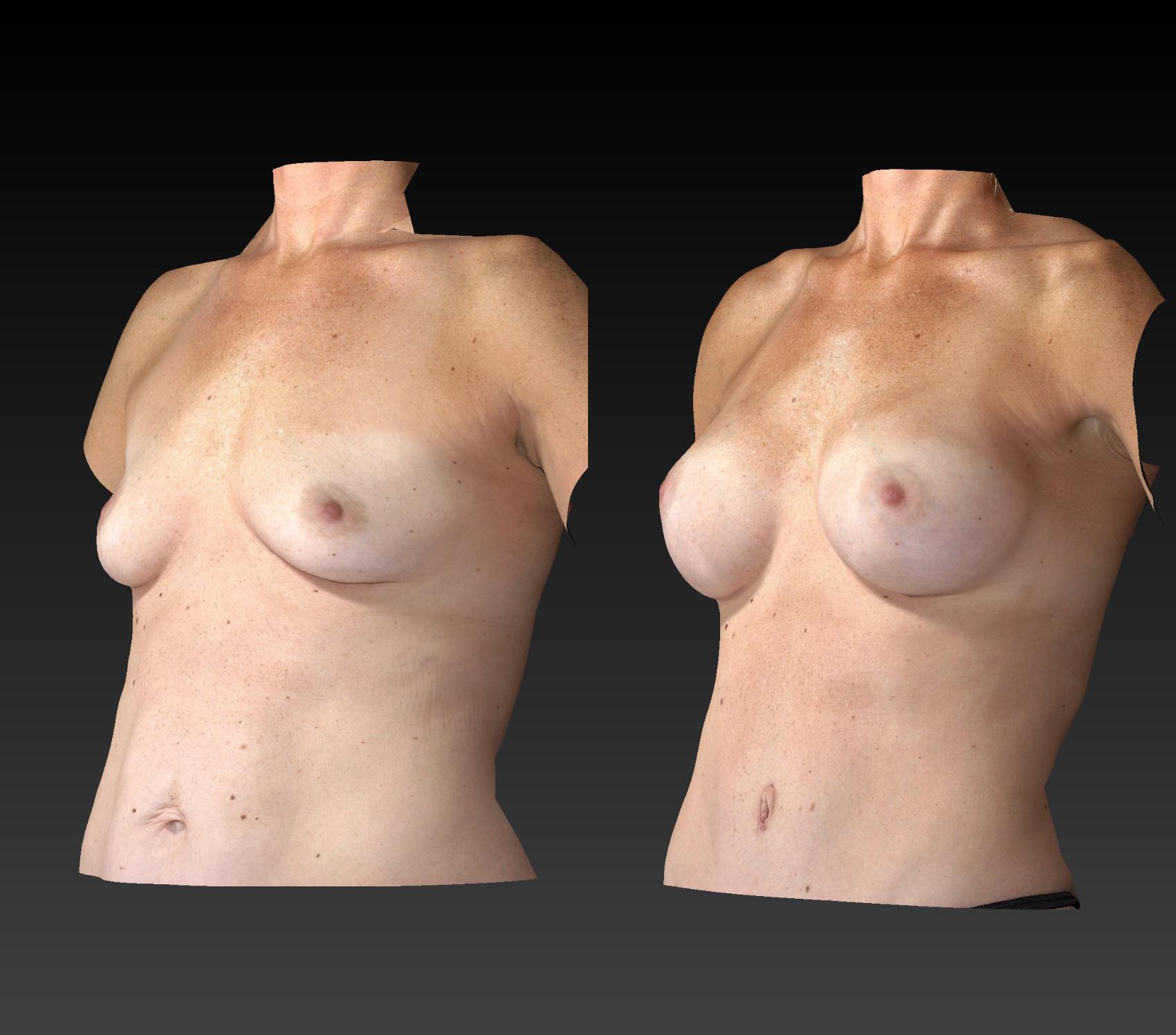Before & After Body Contouring  Procedures Case 247 View #3 View in Toledo, Ohio