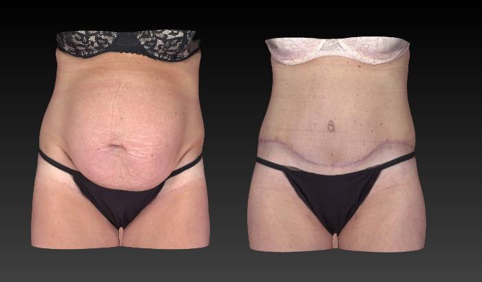 Before & After Body Contouring  Procedures Case 275 View #1 View in Toledo, Ohio