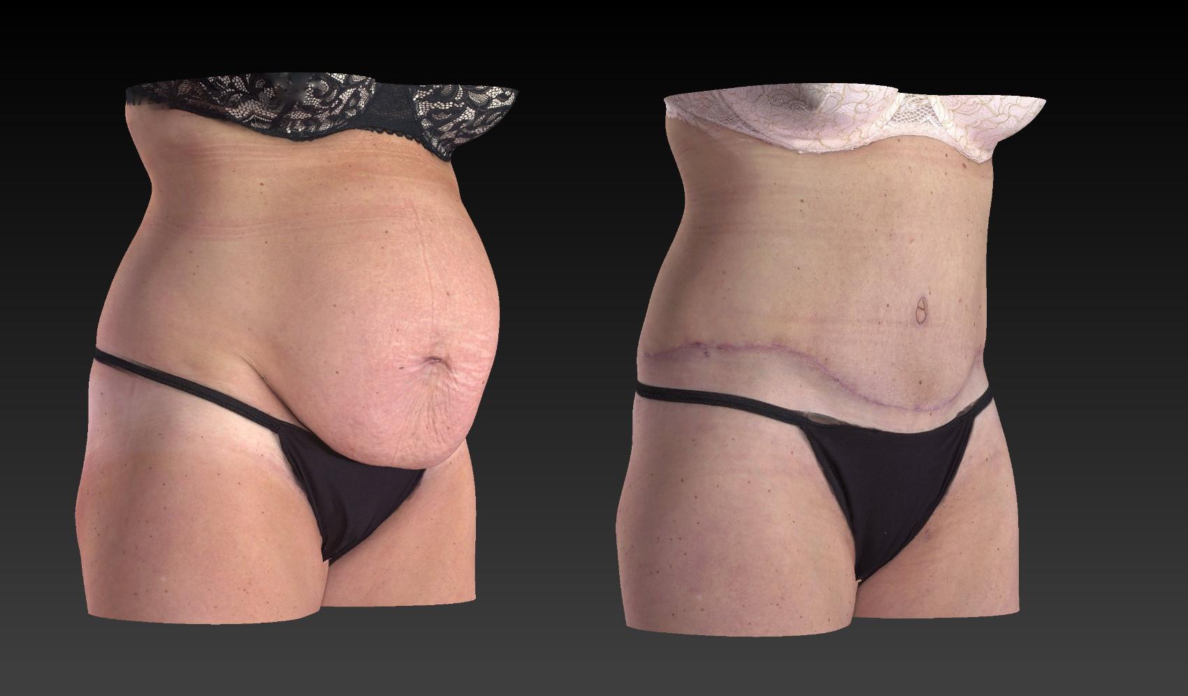 Before & After Body Contouring  Procedures Case 275 View #2 View in Toledo, Ohio