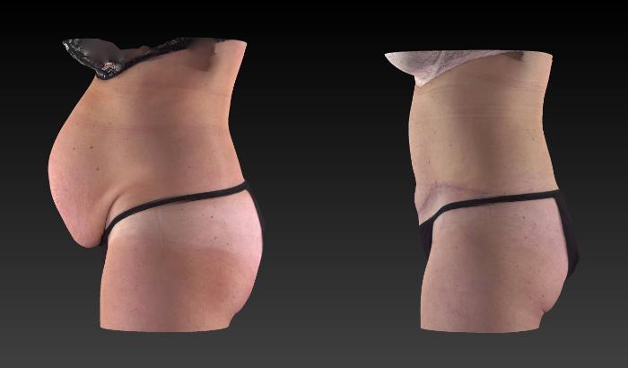 Before & After Body Contouring  Procedures Case 275 View #3 View in Toledo, Ohio