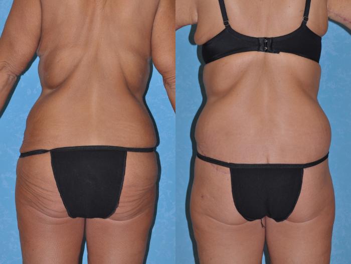 Before & After Body Lift Case 128 Back View in Toledo, Ohio