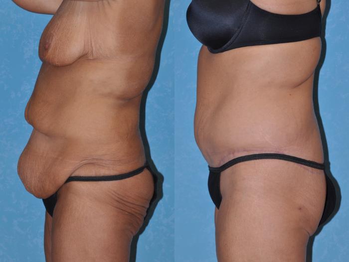 Before & After Body Lift Case 128 Left Side View in Toledo, Ohio