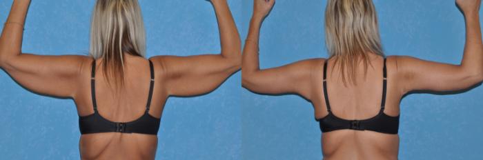 Before & After Body Lift Case 128 Posterior Arms View in Toledo, Ohio