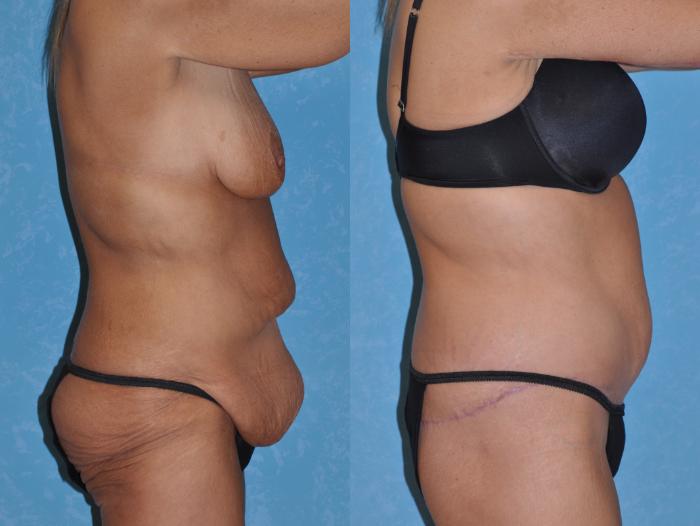Before & After Body Lift Case 128 Right Side View in Toledo, Ohio