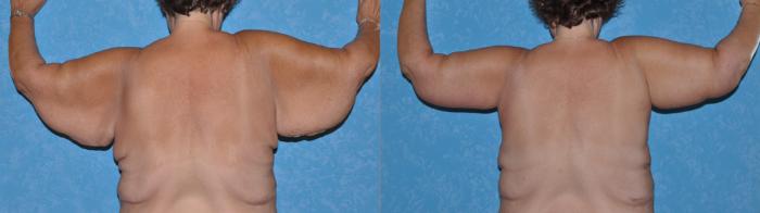 Before & After Body Lift Case 144 Back View in Toledo, Ohio