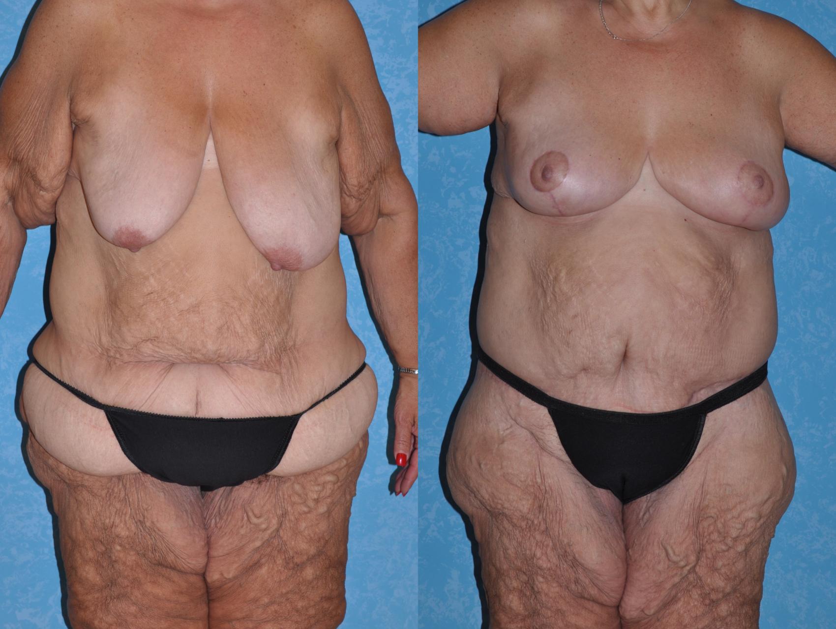 Before & After Body Lift Case 144 Front View in Toledo, Ohio