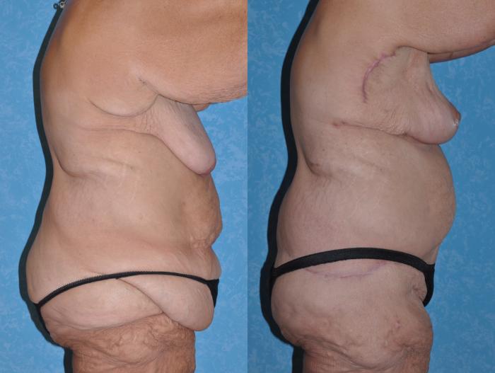 Before & After Body Lift Case 144 Right Side View in Toledo, Ohio