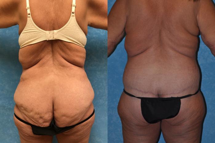 Before & After Body Lift Case 298 Back View in Toledo, Ohio