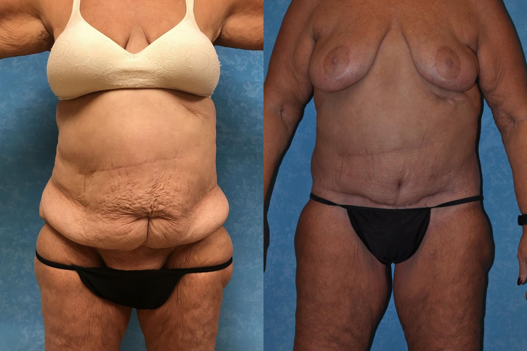 Before & After Body Lift Case 298 Front View in Toledo, Ohio