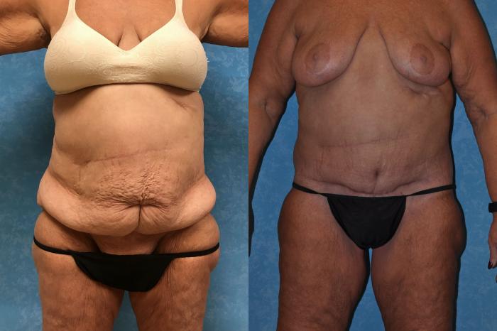 Before & After Body Lift Case 298 Front View in Toledo, Ohio