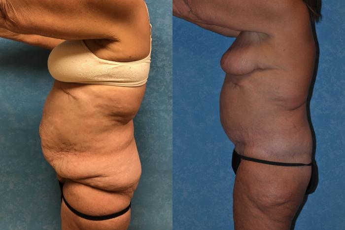 Before & After Body Lift Case 298 Left Side View in Toledo, Ohio