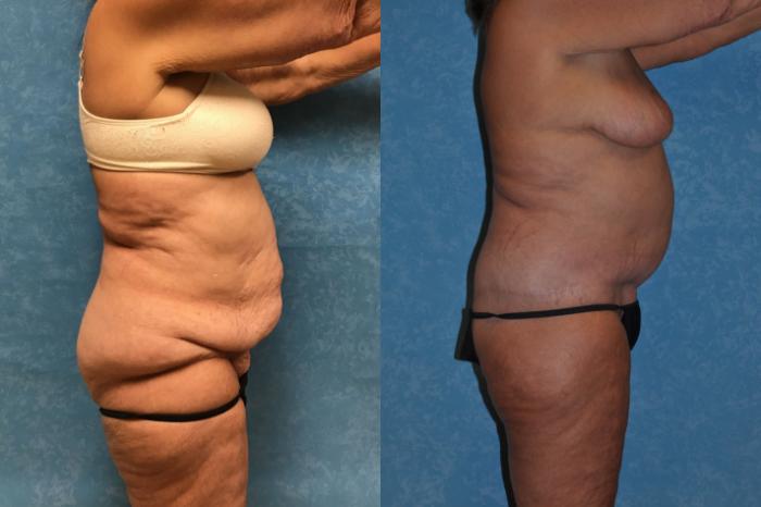 Before & After Body Lift Case 298 Right Side View in Toledo, Ohio