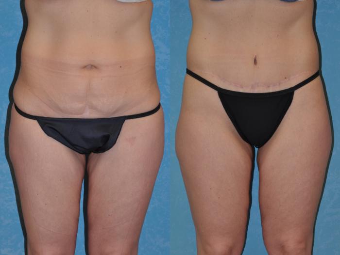 Before & After Body Lift Case 326 Front View in Toledo, Ohio