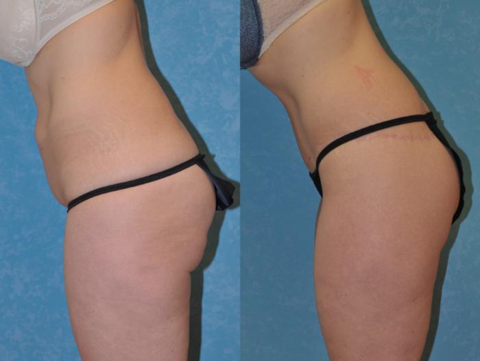 Before & After Body Lift Case 326 Left Side View in Toledo, Ohio