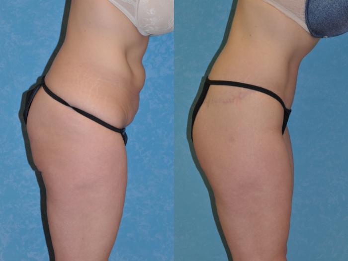 Before & After Body Lift Case 326 Right Side View in Toledo, Ohio