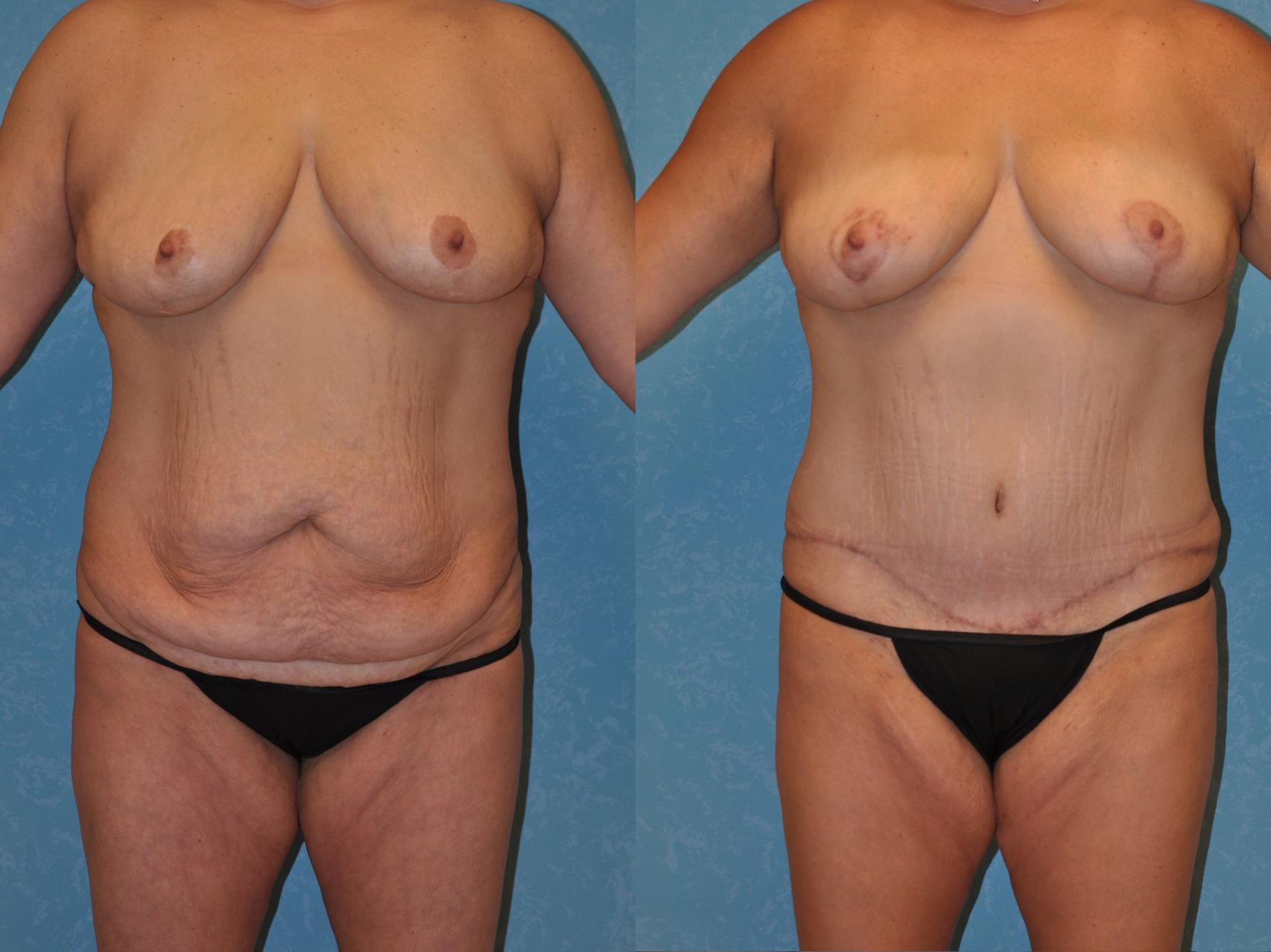 Before & After Breast Lift Case 418 Front View in Toledo, Ohio