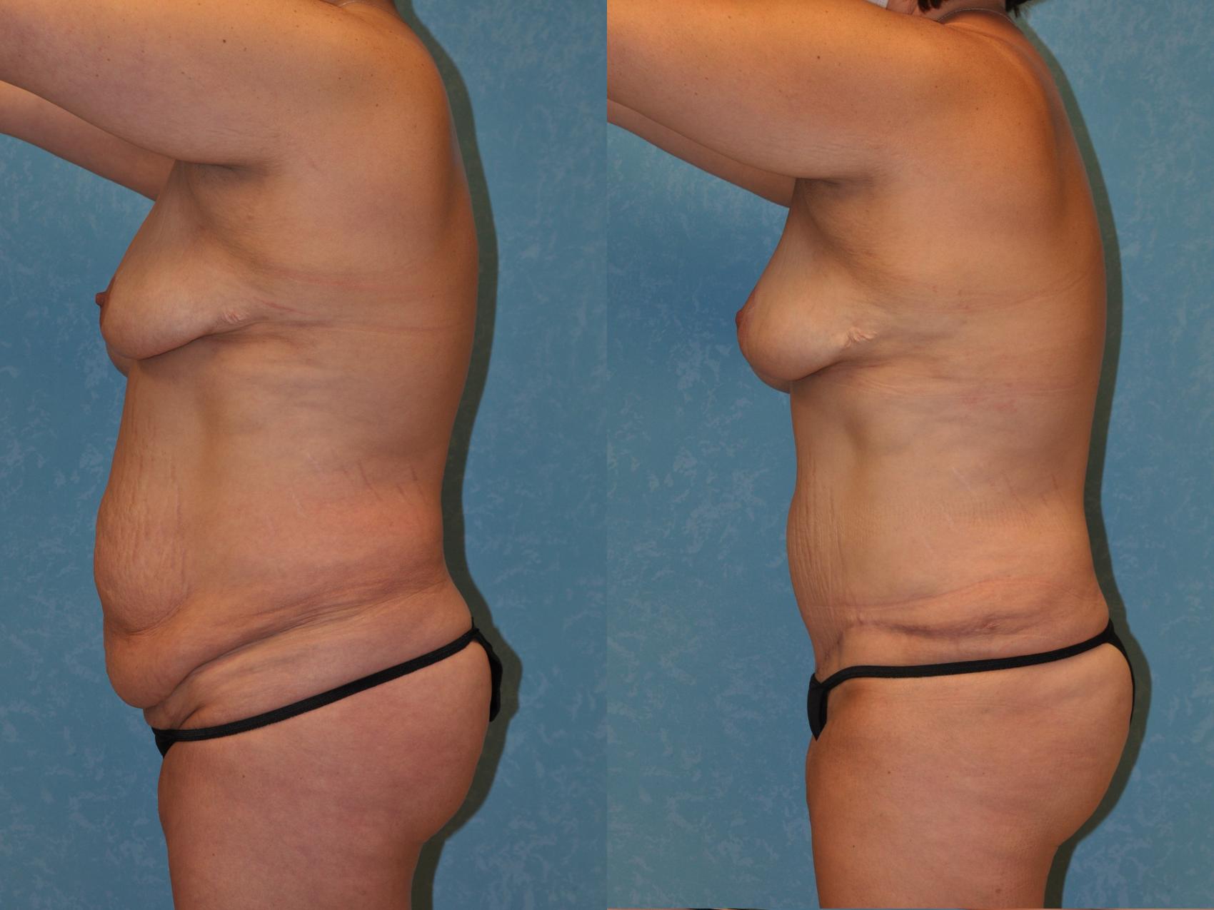 Before & After Liposuction Case 418 Left Side View in Toledo, Ohio