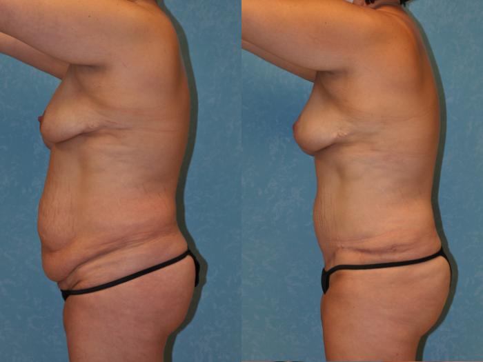 Before & After Breast Lift Case 418 Left Side View in Toledo, Ohio