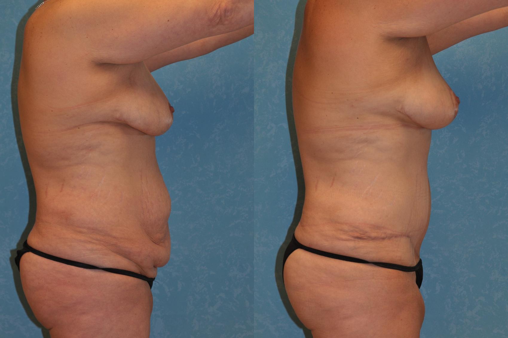 Before & After Liposuction Case 418 Right Side View in Toledo, Ohio