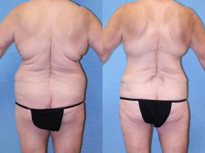 Before & After Body Lift Case 501 Back View in Toledo, Ohio
