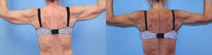 Before & After Body Lift Case 502 Posterior View in Toledo, Ohio