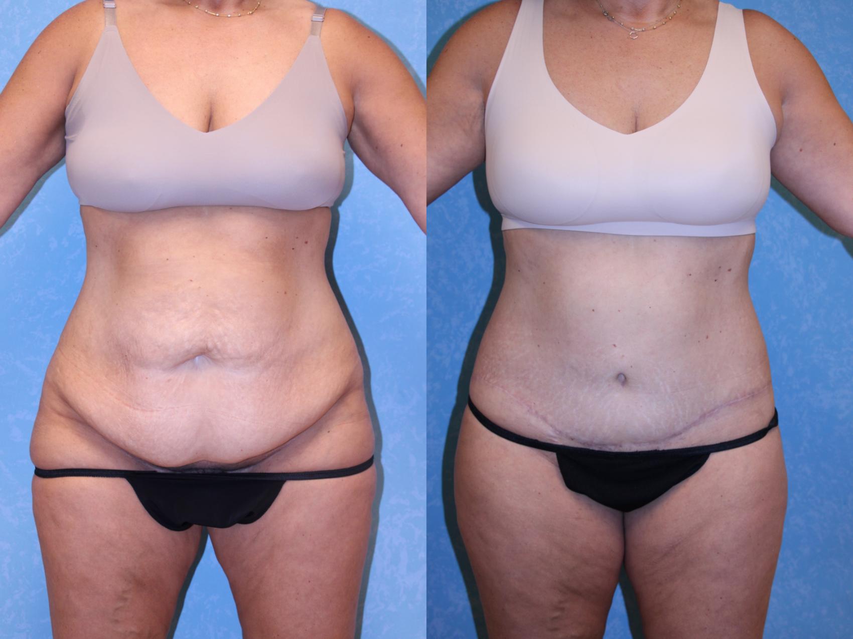 Before & After Body Lift Case 557 Front View in Toledo, Ohio