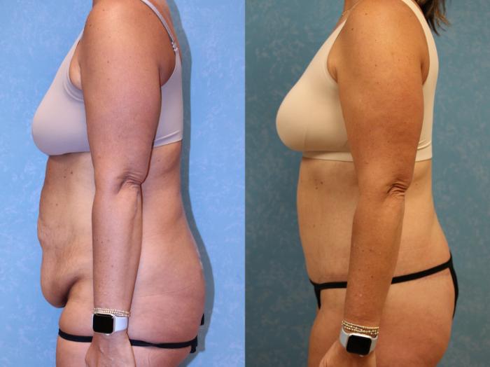 Before & After Body Lift Case 557 Left Side View in Toledo, Ohio